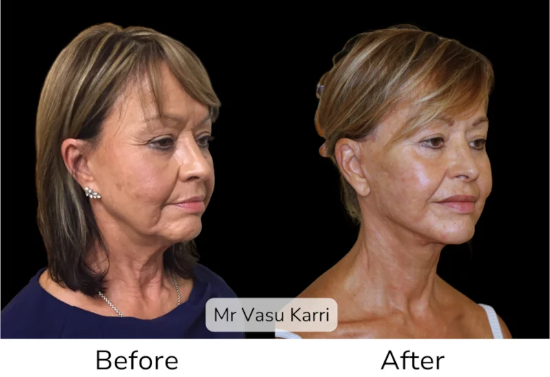 Facelift Patient 7 View 3